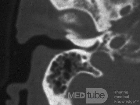 Exostosis of the External Canal CT Scan
