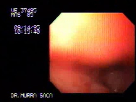 Adenocarcinoma of the Stomach And Esophagus - Endoscopy