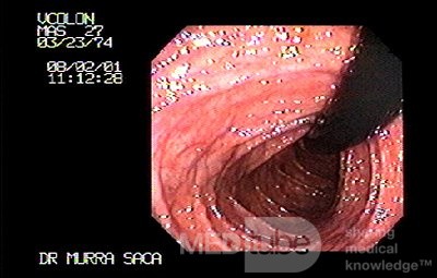 Familial Adenomatous Polyposis of the Colon (14 of 30)