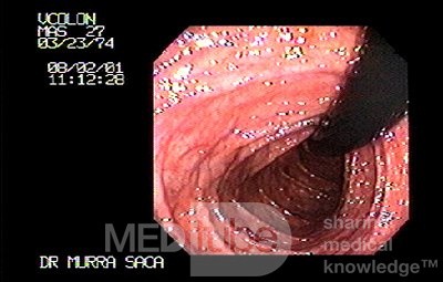 Familial Adenomatous Polyposis of the Colon (14 of 30)