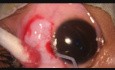 Excision of a Large Naevus Conjunctiva