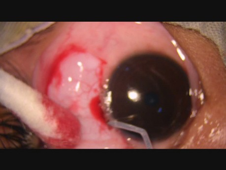 Excision of a Large Naevus Conjunctiva