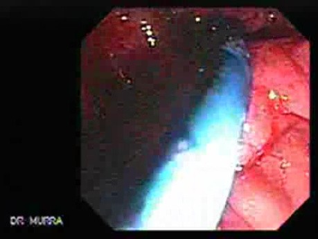 Adenocarcinoma of the Vater Papilla - Stent Migration (3 of 7)