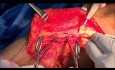 Latissimus Dorsi Flap