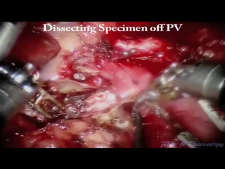 Robotic Pancreaticoduodenectomy with Cholecystectomy