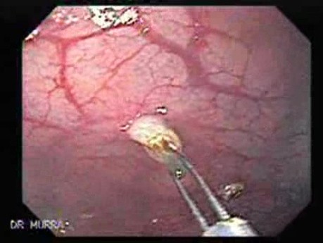 Juvenile Non Familial Polyposis of the Colon (35 of 37)