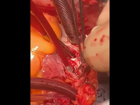 SVC Reconstruction with Autologous Pericardial Patch in Patient with Bacterial Endocarditis