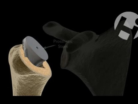 Total Shoulder Arthroplasty