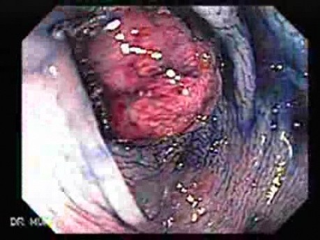 Colonoscopic Polypectomy (6 of 23)