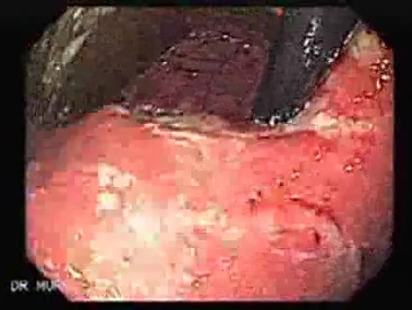 Synchronous Cancer Gastric and Esophageal (3 of 9 )