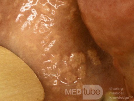 Fordyce Spots Oral Mucosa