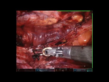 Video Case of Germinative Cells Tumor - Post Chemo