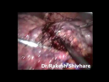 Laparoscopic liver resection of HCC - male patient
