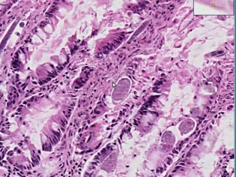 Ileum Strongyloides enterit
