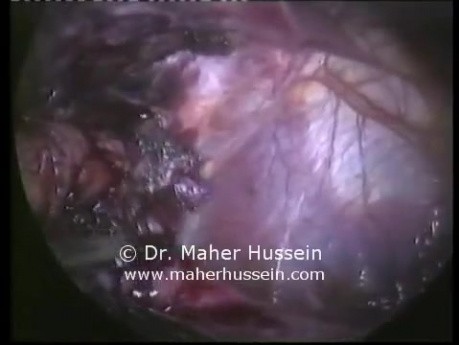 Laparoscopic Revision of Gastric Bypass