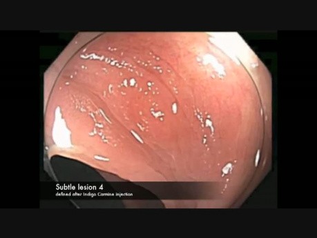 Colonoscopy Channel - Subtle Lesions In The Colon