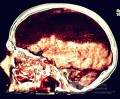 Acute Spontaneous Subdural Hemorrhage in the Subdural Space