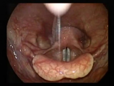 Laryngeal Tremors