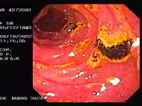 Multiple Duodenal Ulcers (2 of 3)