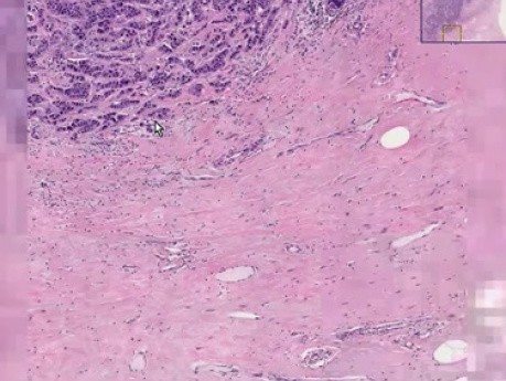 Ductal carcinoma - Histopathology - Breast