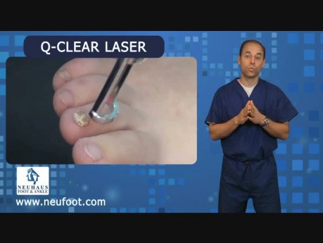 New Laser Treatment for Toenail Fungus