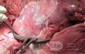 Plastic Linitis with bilateral Krukenberg´s tumor (3 of 13)