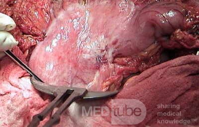 Plastic Linitis with bilateral Krukenberg´s tumor (3 of 13)