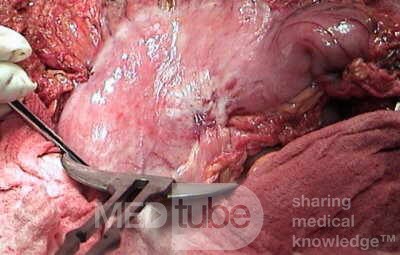 Plastic Linitis with bilateral Krukenberg´s tumor (3 of 13)
