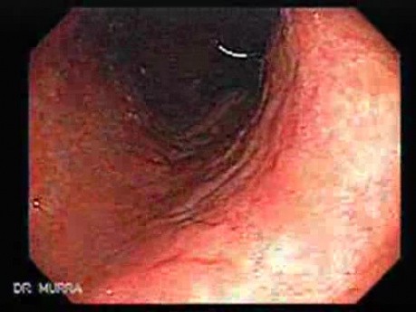 Chronic Gastritis (1 of 8)