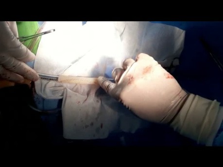 Complete SVCS Reconstruction of SVC with Tubularized Bovine Pericardial SVC 