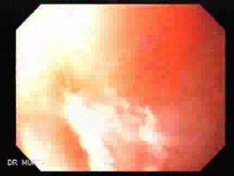 Squamous cell carcinoma of the larynx - hemorrhagic esophagitis (3 of 4)
