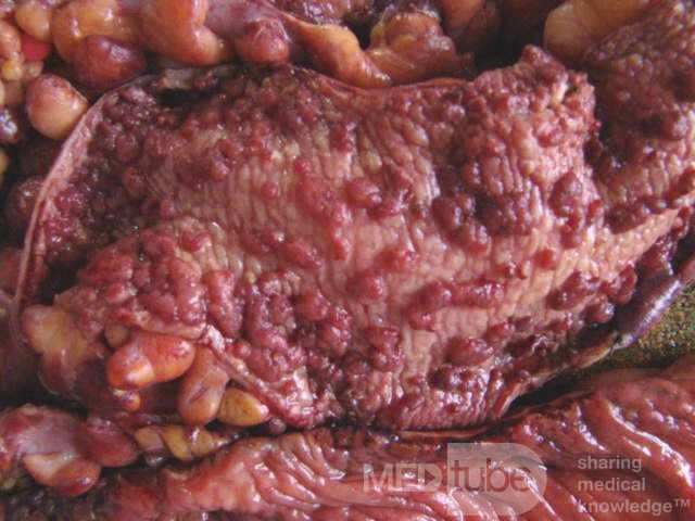 Multiple Rectal Ulcers (100 of 110)