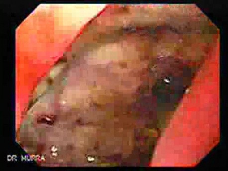 Adenocarcinoma of the Antrum with Duodenal Infiltration (1 of 3)
