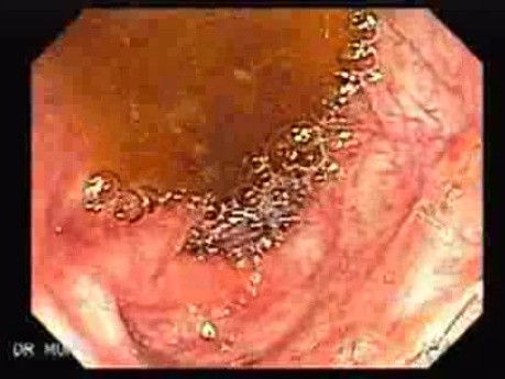 Colitis Ulcerosa - Pseudopolyps (6 of 22)