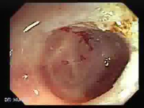 Polyp Inside Of A Diverticulum (11 of 12)