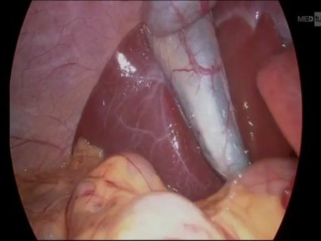 Laparoscopic Cholecystectomy