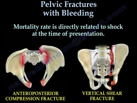 Pelvic Fractures With Bleeding 