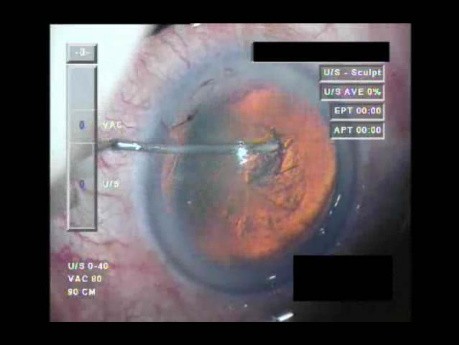 Cataract Surgery XII - Part 1
