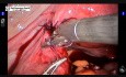Robotic Reversal of Tubal Sterilization
