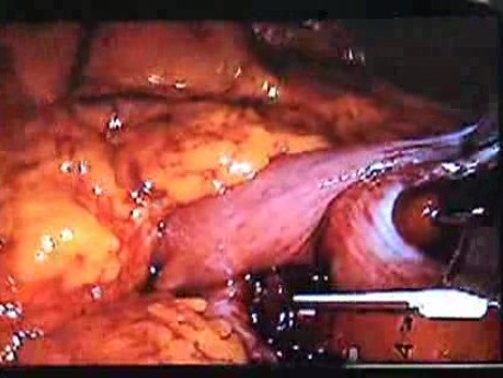 Jejunal Gastrointestinal Stromal tumor (GIST) (45 of 86)