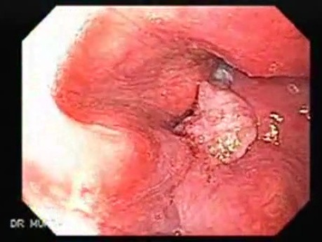 Squamous cell carcinoma of the larynx (1 of 4)