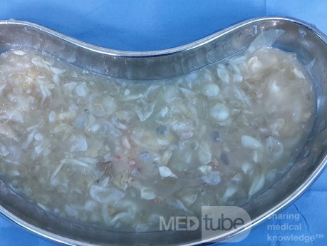 Multiple Daughter Cyst