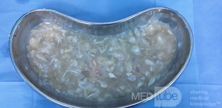 Multiple Daughter Cyst