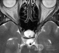 Thornwaldt's Bursa [Cyst] MRI