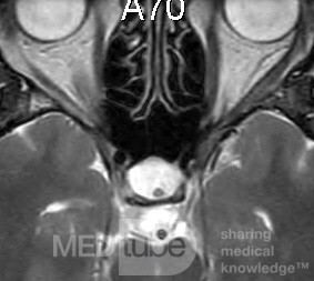 Thornwaldt's Bursa [Cyst] MRI