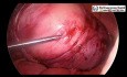 Laparoscopic Surgery For Large Broad Ligament Fibroid