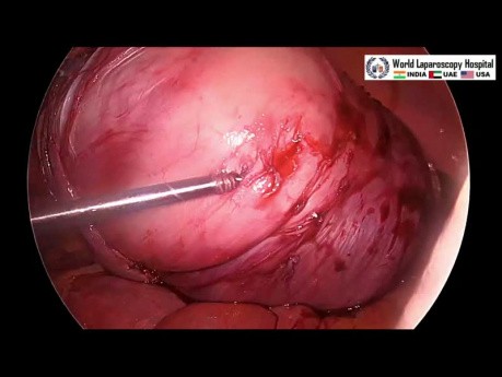 Laparoscopic Surgery For Large Broad Ligament Fibroid
