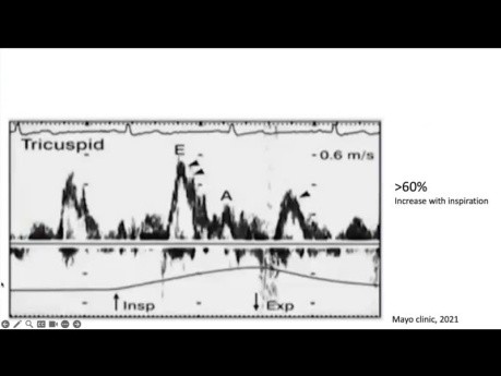 The Role of Echocardiography in Pericardial Diseases