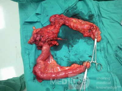 Non-Hodgkin's Lymphoma of the Colon (4 of 16)