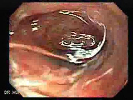 Multiple Duodenal Erosions due to Salmonella Enteritis (3 of 5)